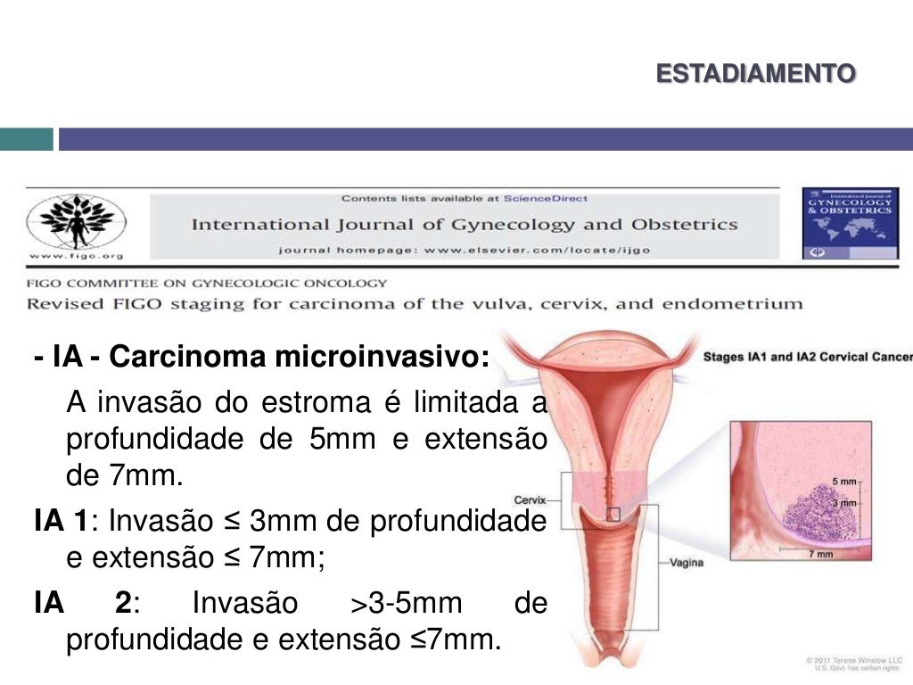 Conduta no carcinoma microinvasivo do colo uterino lpjn