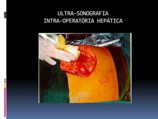 ULTRA-SONOGRAFIA
INTRA-OPERATÓRIA HEPÁTICA
 