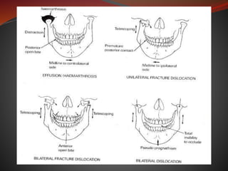 Condylar # | PPTX