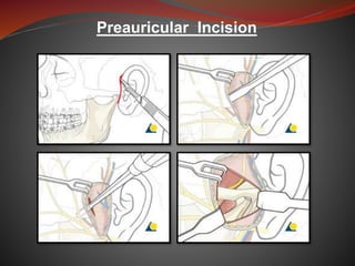 Preauricular Incision Steps Condylar # | PPTX