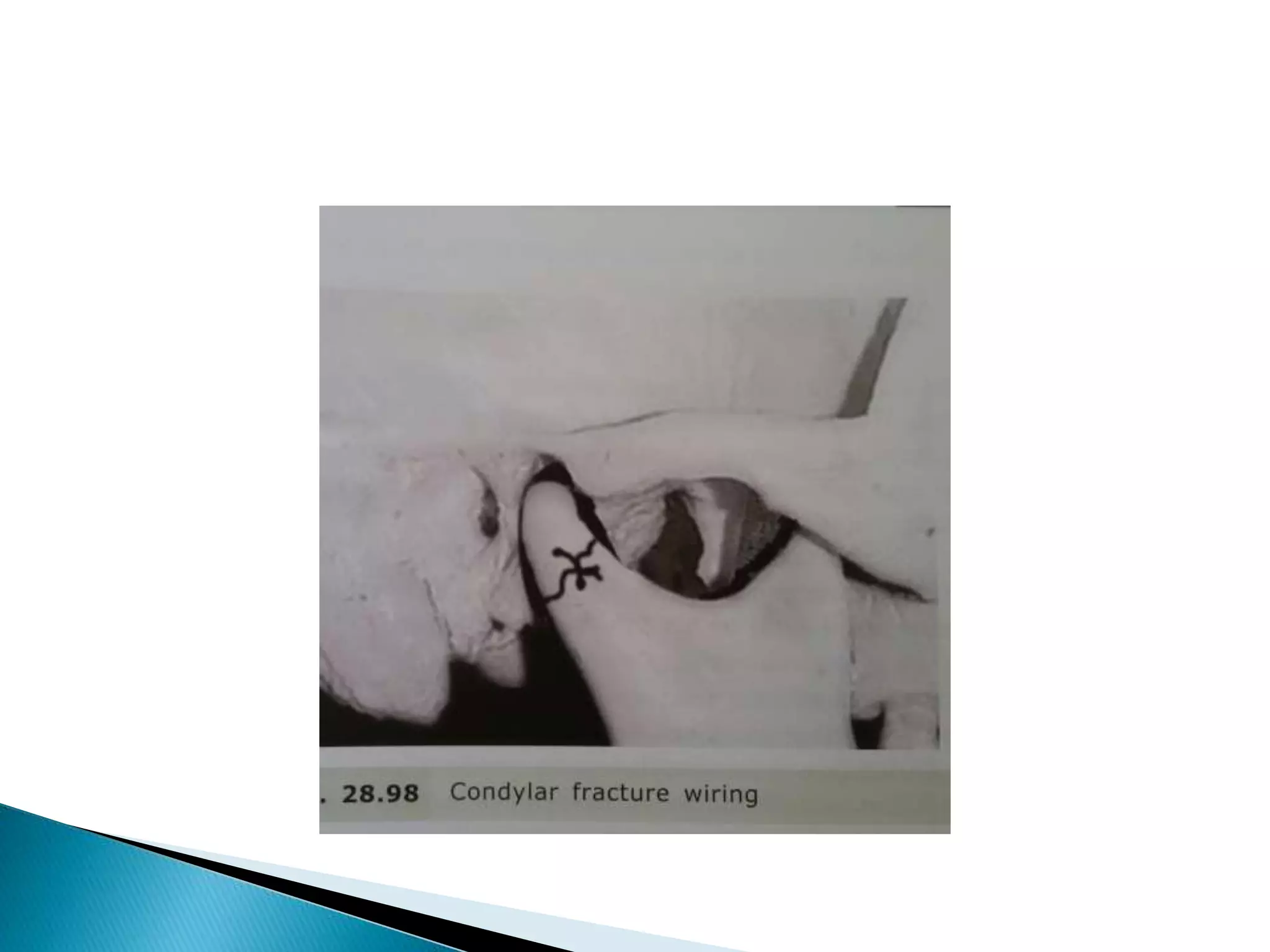 CONDYLAR FRACTURE.pptx