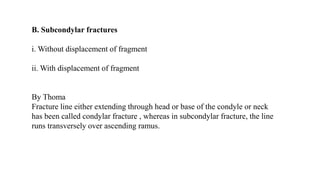 B. Subcondylar fractures
i. Without displacement of fragment
ii. With displacement of fragment
By Thoma
Fracture line either extending through head or base of the condyle or neck
has been called condylar fracture , whereas in subcondylar fracture, the line
runs transversely over ascending ramus.
 