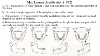 Mac Lennan classification (1952)
a. No Displacement - A crack fracture is seen without alteration of the normal relationship of
TM Joint
b. Deviation - simple angulation of the condylar process to the ramus
c. Displacement - Overlap occurs between the condylar process and the ramus and fractured
fragment lies lateral to the ramus.
d. Dislocation - condylar head is completely disrupted from the glenoid fossa and gets pulled
anteriorly and medially by the lateral pterygoid muscle
 