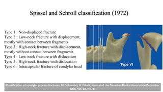 Spissel and Schroll classification (1972)
Type 1 : Non-displaced fracture
Type 2 : Low-neck fracture with displacement,
mostly with contact between fragments
Type 3 : High-neck fracture with displacement,
mostly without contact between fragments
Type 4 : Low-neck fracture with dislocation
Type 5 : High-neck fracture with dislocation
Type 6 : Intracapsular fracture of condylar head
Classification of condylar process fractures; M. Schneider, U. Eckelt; Journal of the Canadian Dental Association December
2006, Vol. 68, No. 11
 