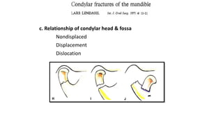 c. Relationship of condylar head & fossa
Nondisplaced
Displacement
Dislocation
 