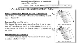 R.A. Loukotaa et al subclassification (2005)
Diacapitular fracture (through the head of the condyle):
The fracture line starts in the articular surface and may extend
outside the capsule.
Fracture of the condylar neck:
The fracture line starts somewhere above line A and in more
than half runs above the line A in the lateral view. Line A is the
perpendicular line through the sigmoid notch to the tangent of
the ramus.
Fracture of the condylar base:
The fracture line runs behind the mandibular foramen and, in
more than half, below line A
 