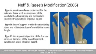 Neff & Rasse’s Modification(2006)
Classification of condylar process fractures; M. Schneider, U. Eckelt; Journal of the Canadian Dental Association December
2006, Vol. 68, No. 11
Type A: continuous bony contact within the
articular fossa, with a component of the
condylar head remaining and the fracture
supported without loss of ramus height
Type B: loss of support within the articulating
fossa and subsequent loss of mandibular ramus
height.
Type C: the uppermost portion of the fracture
is below the level of the lateral ligament,
resulting in a loss of ramus height.
 
