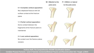 Andreas Neff; The Comprehensive AOCMF Classification System:
Condylar Process Fractures - Level 3 Tutorial; Craniomaxillofacial Trauma and Reconstruction Vol. 7 Suppl. 1/2014
 