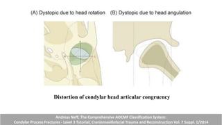 Distortion of condylar head articular congruency
Andreas Neff; The Comprehensive AOCMF Classification System:
Condylar Process Fractures - Level 3 Tutorial; Craniomaxillofacial Trauma and Reconstruction Vol. 7 Suppl. 1/2014
 