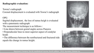 Radiographic evaluation:
Towne’s radiograph
Coronal displacement is evaluated with Towne’s radiograph
OPG
Sagittal displacement, the loss of ramus heigh is evaluated
with a panoramic radiograph
The measurement technique is as follows :
• Line drawn between gonial angles across Panorex
• Perpendicular lines to most superior aspect of condylar
heads
• The difference between the nonfractured and fractured side
equals the change in ramus height.
Raymond.J Fonseca; Oral & maxillofacial trauma; fourth edition; 2013, Saunders, Elsevier Inc
 