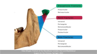 Vikas Dhupar; Fracture of the Mandibular Condyle; Oral and Maxillofacial
Surgery for the Clinician; Springer; 2021
 