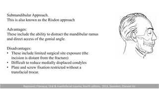 Submandibular Approach.
This is also known as the Risdon approach
Advantages:
These include the ability to distract the mandibular ramus
and direct access of the gonial angle.
Disadvantages:
• These include limited surgical site exposure (the
incision is distant from the fracture)
• Difficult to reduce medially displaced condyles
• Plate and screw fixation restricted without a
transfacial trocar.
Raymond.J Fonseca; Oral & maxillofacial trauma; fourth edition; 2013, Saunders, Elsevier Inc
 