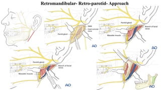 Retromandibular- Retro-parotid- Approach
 