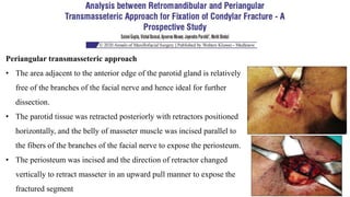 Periangular transmasseteric approach
• The area adjacent to the anterior edge of the parotid gland is relatively
free of the branches of the facial nerve and hence ideal for further
dissection.
• The parotid tissue was retracted posteriorly with retractors positioned
horizontally, and the belly of masseter muscle was incised parallel to
the fibers of the branches of the facial nerve to expose the periosteum.
• The periosteum was incised and the direction of retractor changed
vertically to retract masseter in an upward pull manner to expose the
fractured segment
 