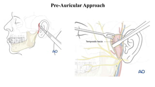 Pre-Auricular Approach
 