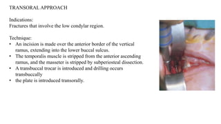 TRANSORAL APPROACH
Indications:
Fractures that involve the low condylar region.
Technique:
• An incision is made over the anterior border of the vertical
ramus, extending into the lower buccal sulcus.
• The temporalis muscle is stripped from the anterior ascending
ramus, and the masseter is stripped by subperiosteal dissection.
• A transbuccal trocar is introduced and drilling occurs
transbuccally
• the plate is introduced transorally.
 