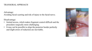 TRANSORAL APPROACH
Advantage:
Avoiding facial scarring and risk of injury to the facial nerve.
Disadvantage:
• limited access, which makes fragment control difficult and the
procedure surgically more challenging.
• It may not be possible to align the posterior border perfectly
and slight errors of reduction are inevitable.
 