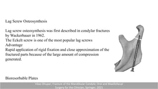 Lag Screw Osteosynthesis
Lag screw osteosynthesis was first described in condylar fractures
by Wackerbauer in 1962.
The Eckelt screw is one of the most popular lag screws
Advantage
Rapid application of rigid fixation and close approximation of the
fractured parts because of the large amount of compression
generated.
Bioresorbable Plates
Vikas Dhupar; Fracture of the Mandibular Condyle; Oral and Maxillofacial
Surgery for the Clinician; Springer; 2021
 