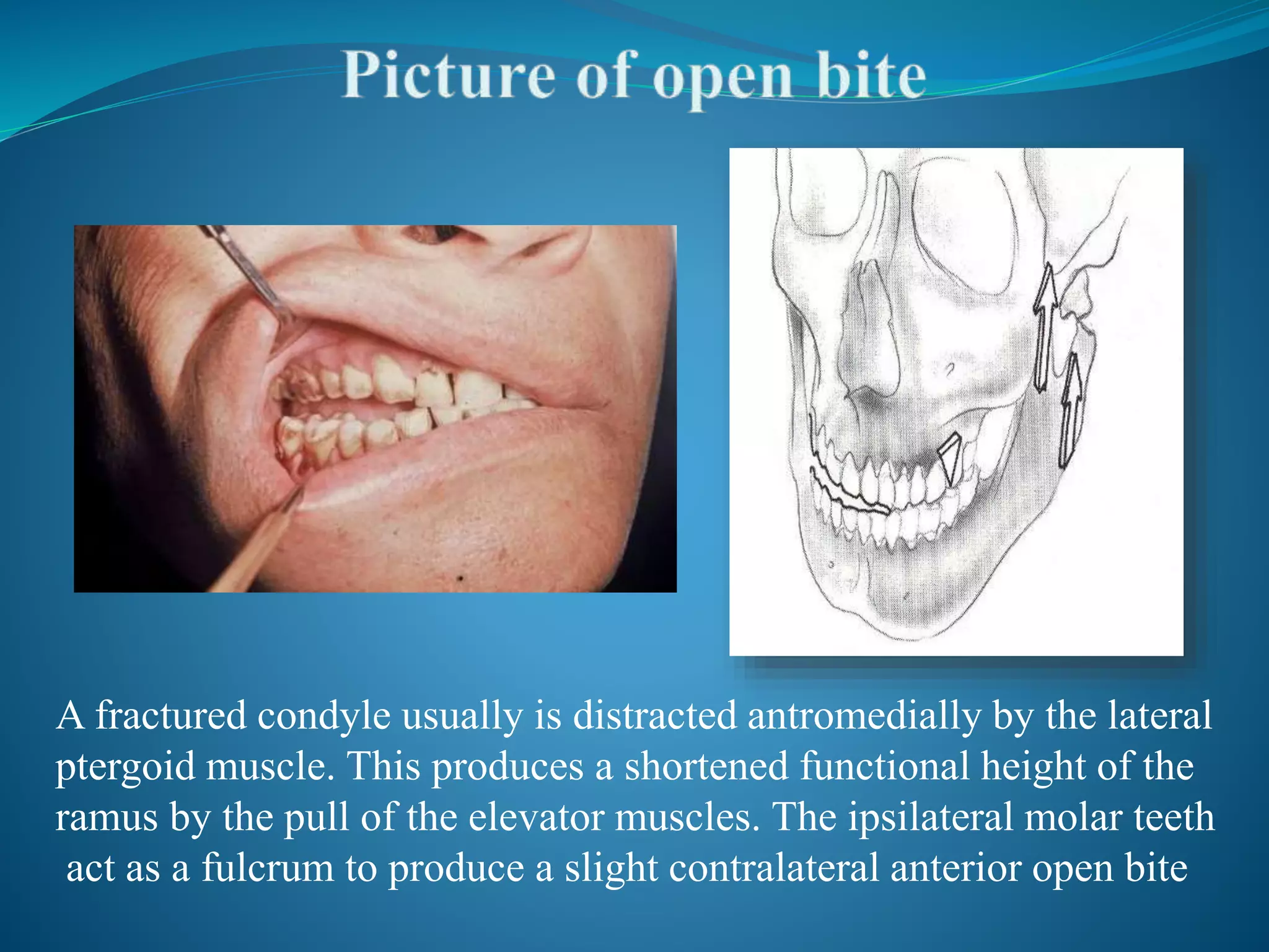 Condylar Fractures | PPTX