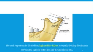 The neckregion can be divided intohigh andlow halves by equallydividingthe distance
betweenthe sigmoid notch line and thelateral pole line. 10
 