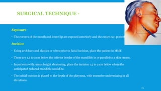 SURGICAL TECHNIQUE -
Exposure
 The corners of the mouth and lower lip are exposed anteriorly and the entire ear, posteriorly.
Incision
 Using arch bars and elastics or wires prior to facial incision, place the patient in MMF.
 These are 1.5 to 2 cm below the inferior border of the mandible in or parallel to a skin crease.
 In patients with ramus height shortening, place the incision 1.5 to 2 cm below where the
anticipated reduced mandible would be.
 The initial incision is placed to the depth of the platysma, with extensive undermining in all
directions.
114
 