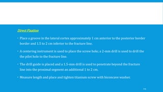Direct Fixation
 Place a groove in the lateral cortex approximately 1 cm anterior to the posterior border
border and 1.5 to 2 cm inferior to the fracture line.
 A centering instrument is used to place the screw hole; a 2-mm drill is used to drill the
the pilot hole to the fracture line.
 The drill guide is placed and a 1.5-mm drill is used to penetrate beyond the fracture
line into the proximal segment an additional 1 to 2 cm.
 Measure length and place and tighten titanium screw with biconcave washer.
119
 