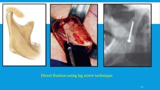 Direct fixation using lag screw technique
120
 
