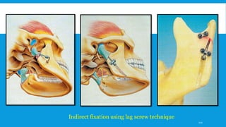 Indirect fixation using lag screw technique
122
 