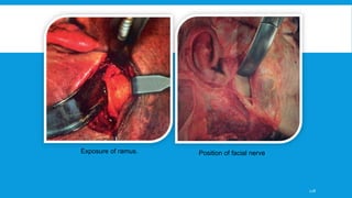 Position of facial nerveExposure of ramus.
128
 