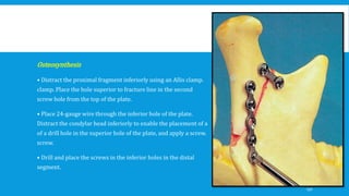Osteosynthesis
• Distract the proximal fragment inferiorly using an Allis clamp.
clamp. Place the hole superior to fracture line in the second
screw hole from the top of the plate.
• Place 24-gauge wire through the inferior hole of the plate.
Distract the condylar head inferiorly to enable the placement of a
of a drill hole in the superior hole of the plate, and apply a screw.
screw.
• Drill and place the screws in the inferior holes in the distal
segment.
130
 