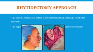 RHYTIDECTOMY APPROACH
 This uses the same access as that of the retromandibular approach, with better
cosmesis.
 This approach must be drained with closed suction drainage postoperatively.
132
 