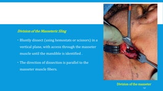 Division of the Masseteric Sling
 Bluntly dissect (using hemostats or scissors) in a
vertical plane, with access through the masseter
muscle until the mandible is identified .
 The direction of dissection is parallel to the
masseter muscle fibers.
Division of the masseter
137
 