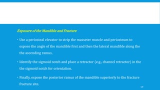 Exposure of the Mandible and Fracture
 Use a periosteal elevator to strip the masseter muscle and periosteum to
expose the angle of the mandible first and then the lateral mandible along the
the ascending ramus.
 Identify the sigmoid notch and place a retractor (e.g., channel retractor) in the
the sigmoid notch for orientation.
 Finally, expose the posterior ramus of the mandible superiorly to the fracture
fracture site.
138
 