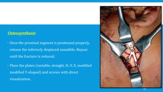 Osteosynthesis
 Once the proximal segment is positioned properly,
release the inferiorly displaced mandible. Repeat
until the fracture is reduced.
 Place the plates (variable, straight, H, U, X, modified
modified Y-shaped) and screws with direct
visualization.
139
 