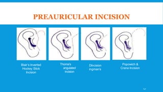 PREAURICULAR INCISION
Blair’s Inverted
Hockey Stick
Incision
Thoma’s
angulated
incision
DIncision
ingman’s
Popowich &
Crane Incision
147
 