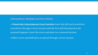Osteosynthesis: Miniplate and Screw Fixation
• Preauricular transcutaneous trocar insertion. Insert the drill and screwdriver
screwdriver through a trocar incision with the first drill hole placed in the
proximal fragment. Insert the screw and plate via a transoral incision.
• Other screws and drill holes are placed through a trocar incision.
157
 
