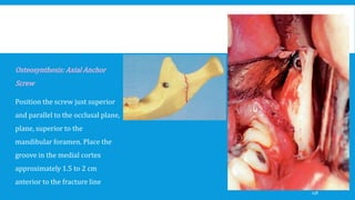 Osteosynthesis: Axial Anchor
Screw
Position the screw just superior
and parallel to the occlusal plane,
plane, superior to the
mandibular foramen. Place the
groove in the medial cortex
approximately 1.5 to 2 cm
anterior to the fracture line
158
 