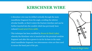 KIRSCHNER WIRE
 A Kirschner wire may be drilled vertically through the main
mandibular fragment from the angle, avoiding the inferior
alveolar bundle, so that it enters the fracture interface and can be
further inserted into the condyle which has previously been
reduced (Lund 1972) (Vero 1968).
 This technique has been modified by Brown & Obeid (1984)
whereby the Kirschner wire is inserted into the proximal condylar
fragment and after this a groove is cut for its base in the main
distal mandibular fragment; two interosseous wires are then used
to secure the basal part of the pin.
Brown & Obeid (1984)177
 