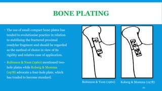 BONE PLATING
 The use of small compact bone plates has
tended to evolutionise practice in relation
to stabilising the fractured proximal
condylar fragment and should be regarded
as the method of choice in view of its
rigidity and relative ease of application.
 Robinson & Yoon (1960) mentioned two-
hole plates while Koberg & Momma
(1978) advocate a four-hole plate, which
has tended to become standard.
Robinson & Yoon (1960) Koberg & Momma (1978)
180
 