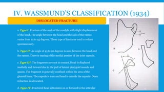 IV. WASSMUND’S CLASSIFICATION (1934)
a. Type I: Fracture of the neck of the condyle with slight displacement
of the head. The angle between the head and the axis of the ramus
varies from 10 to 45 degrees. These type of fractures tend to reduce
spontaneously.
b. Type II: An angle of 45 to 90 degrees is seen between the head and
the ramus. There is tearing of the medial portion of the joint capsule.
c. Type III: The fragments are not in contact. Head is displaced
medially and forward due to the pull of lateral pterygoid muscle and
spasm. The fragment is generally confined within the area of the
glenoid fossa. The capsule is torn and head is outside the capsule. Open
reduction is advocated.
d. Type IV: Fractured head articulates on or forward to the articular
DISLOCATED FRACTURE
24
 