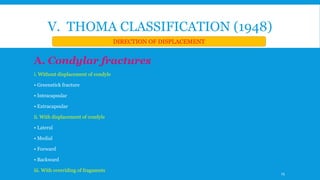 V. THOMA CLASSIFICATION (1948)
A. Condylar fractures
i. Without displacement of condyle
• Greenstick fracture
• Intracapsular
• Extracapsular
ii. With displacement of condyle
• Lateral
• Medial
• Forward
• Backward
iii. With overriding of fragments
DIRECTION OF DISPLACEMENT
25
 