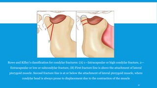 Rowe and Killey’s classification for condylar fractures: (A) 1—Intracapsular or high condylar fracture, 2—
Extracapsular or low or subcondylar fracture, (B) First fracture line is above the attachment of lateral
pterygoid muscle. Second fracture line is at or below the attachment of lateral pterygoid muscle, where
condylar head is always prone to displacement due to the contraction of the muscle
32
 
