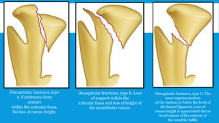 Diacapitular fractures, type
A. Continuous bony
contact
within the articular fossa.
No loss of ramus height.
Diacapitular fractures, type B. Loss
of support within the
articular fossa and loss of height of
the mandibular ramus.
Diacapitular fractures, type C. The
most superior portion
of the fracture is below the level of
the lateral ligament. Loss of
ramus height is appreciated due to
involvement of the entirety of
the condylar head.40
 
