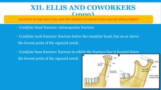 XII. ELLIS AND COWORKERS
(1999)
 Condylar head fracture: intracapsular fracture
 Condylar neck fracture: fracture below the condylar head, but on or above
the lowest point of the sigmoid notch
 Condylar base fracture: fracture in which the fracture line is located below
the lowest point of the sigmoid notch
LOCATION OF THE FRACTURE AND THE DEGREE OF DISLOCATION AND/OR DISPLACEMENT
41
 