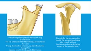 Strausbourg Osteosynthesis Research Group
classification.
The key landmark in the Strausbourg Osteosynthesis
Research
Group classification is Line A, a perpendicular line
through the
sigmoid notch to the tangent of the ramus.
Diacapitular fracture extending
outside the temporomandibular
joint capsule without
displacement of the articulating
surface of the condylar head.
44
 