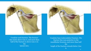 Condylar neck fracture. The fracture
line starts above Line A, and more than
half of the fracture is above Line A in
the
lateral view.
Condylar base (subcondylar) fracture. The
fracture line runs posterior to the
mandibular foramen, and more than half
the
length of the fracture extends below Line
A. 45
 