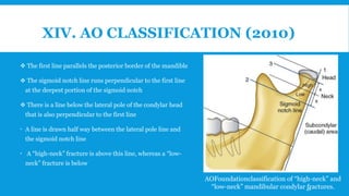 XIV. AO CLASSIFICATION (2010)
 The first line parallels the posterior border of the mandible
 The sigmoid notch line runs perpendicular to the first line
at the deepest portion of the sigmoid notch
 There is a line below the lateral pole of the condylar head
that is also perpendicular to the first line
 A line is drawn half way between the lateral pole line and
the sigmoid notch line
 A “high-neck” fracture is above this line, whereas a “low-
neck” fracture is below
AOFoundationclassification of “high-neck” and
“low-neck” mandibular condylar fractures.46
 