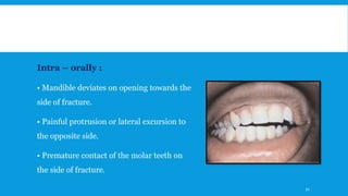 Intra – orally :
• Mandible deviates on opening towards the
side of fracture.
• Painful protrusion or lateral excursion to
the opposite side.
• Premature contact of the molar teeth on
the side of fracture.
51
 