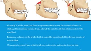  Clinically, it will be noted that there is asymmetry of the face on the involved side due to,
shifting of the mandible posteriorly and laterally towards the affected side (deviation of the
mandible).
 Premature occlusion on the involved side is caused by upward pull of the elevator muscles of
the mandible.
 This results in a class I lever with the fulcrum on the molar teeth on the involved side.
71
 