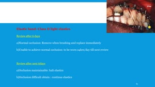 Elastic band–Class II light elastics
Review after 6 days
a)Normal occlusion: Remove when brushing and replace immediately
b)Unable to achieve normal occlusion: to be worn 24hrs/day till next review
Review after next 6days
a)Occlusion maintainable: halt elastics
b)Occlusion difficult obtain : continue elastics
81
 